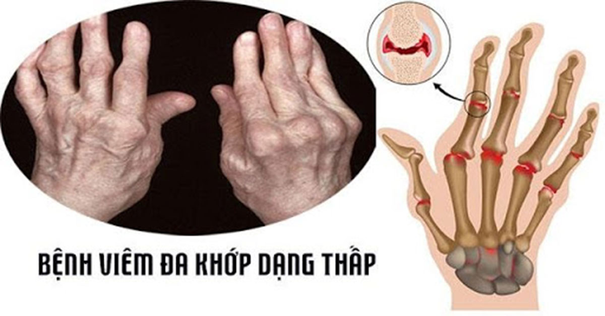 Viêm đa khớp dạng thấp là gì và những thông tin liên quan đến bệnh