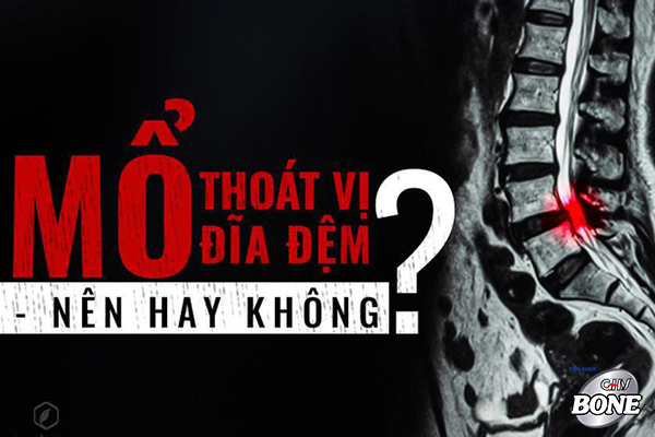 benh-thoat-vi-dia-dem-co-nen-mo-khong (3)