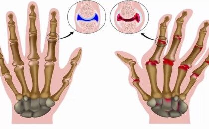 Hướng điều trị viêm khớp dạng thấp mới nhất