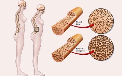 5 phương pháp phòng ngừa bệnh loãng xương hiệu quả