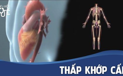 Những điều cần biết về bệnh thấp khớp cấp