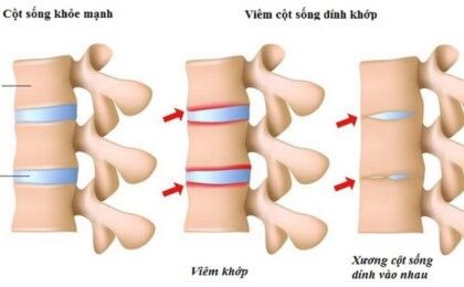 Chữa viêm cột sống dính khớp bằng phương pháp đông y