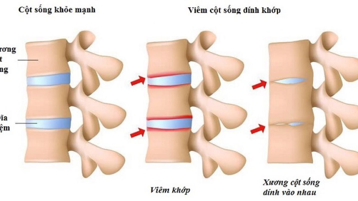 Bệnh viêm cột sống dính khớp