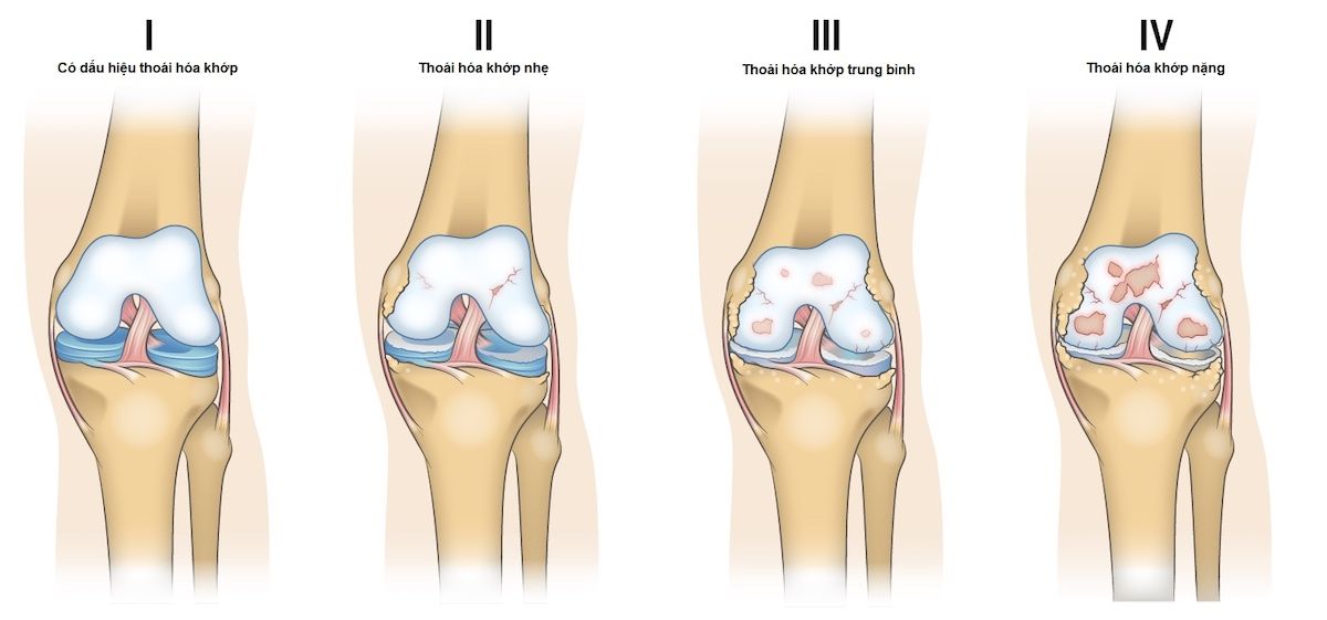 Thoái hoá khớp gối