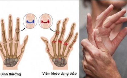 Bệnh viêm khớp dạng thấp và hướng điều trị