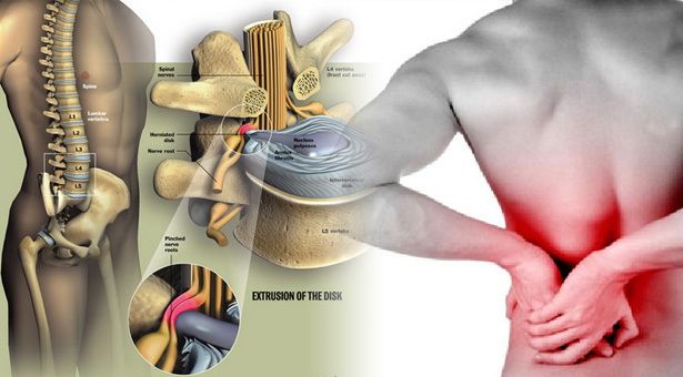 Bệnh loãng xương cũng có thể do ảnh hưởng của quá trình điều trị một số bệnh khác