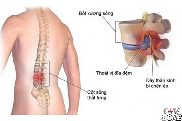 Nguyên nhân gây ra thoát vị đĩa đệm là gì?