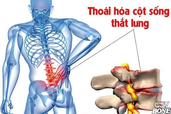 Thoái hóa cột sống thắt lưng là quá trình tổn thương ở phần đĩa đệm