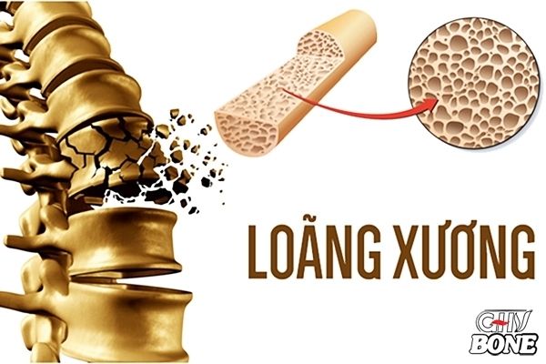 Dấu hiệu bạn bị loãng xương mà không biết?