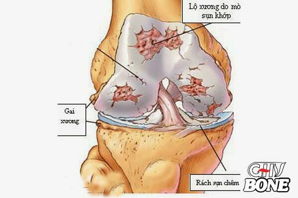 Mòn sụn khớp có thể gây viêm khớp mạn tính