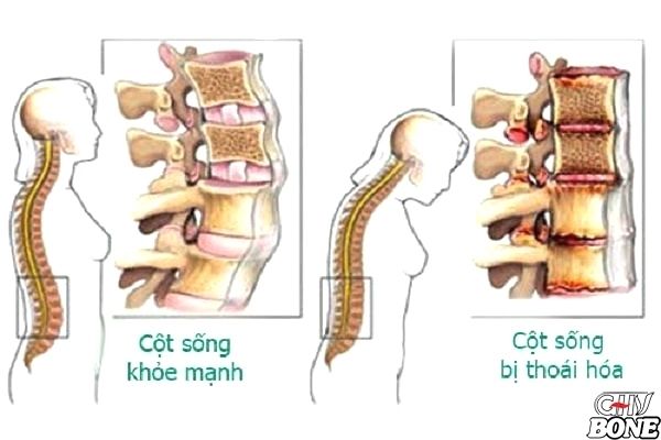 Phương pháp điều trị thoái hóa cột sống thắt lưng