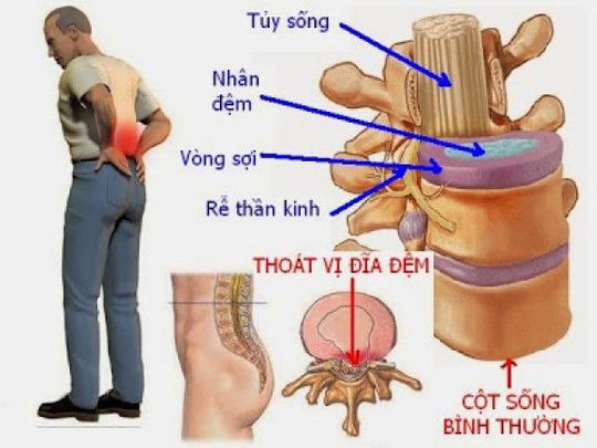 Phương pháp điều trị thoát vị đĩa đệm