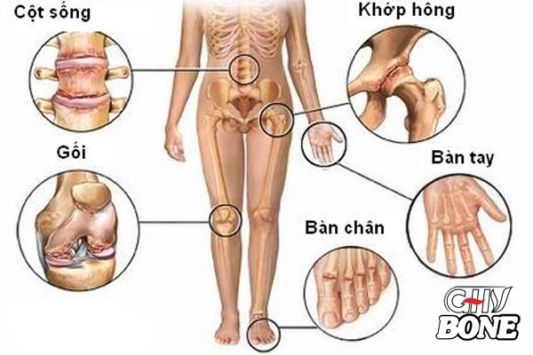 Viêm đa khớp xảy ra ở nhiều khớp cùng lúc