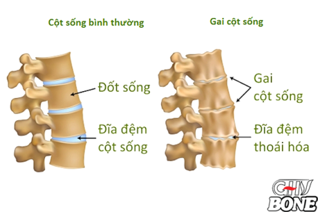 Nguyên nhân chính dẫn tới gai cột sống là gì?