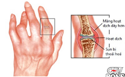 Đau khớp ngón tay là do đâu?