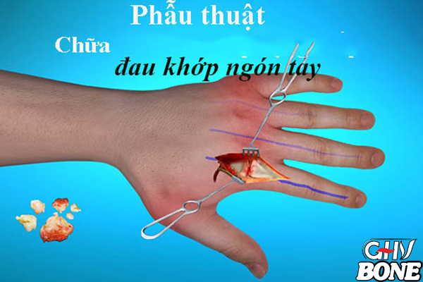 Phương pháp điều trị bệnh đau khớp ngón tay