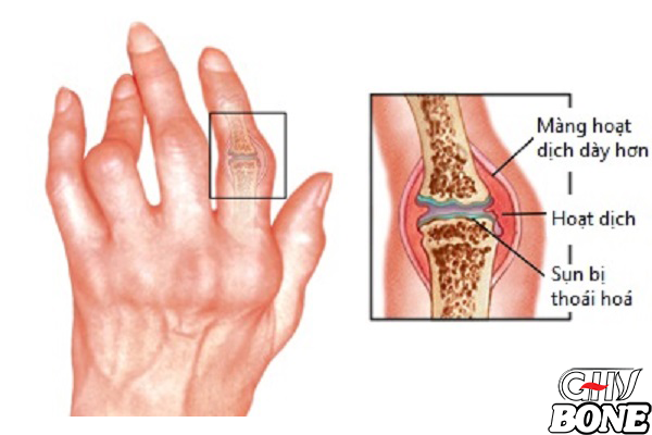 Đau khớp ngón tay do đâu?