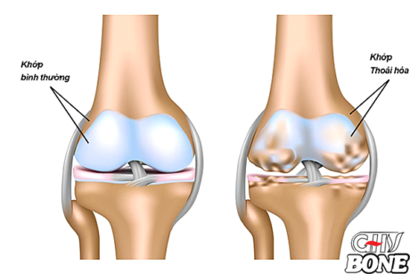 Triệu chứng của bệnh thoái hóa khớp