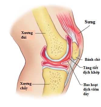 Viêm khớp tràn dịch?