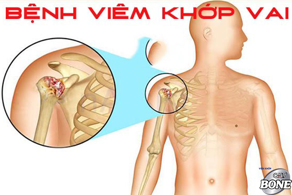 Các phương pháp điều trị đau khớp vai