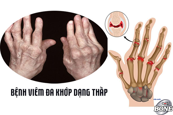 Hình ảnh viêm đa khớp dạng thấp