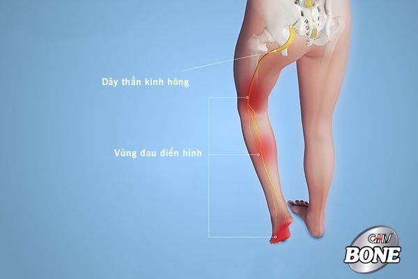 Đau thần kinh tọa là triệu chứng của thoát vị đĩa đệm