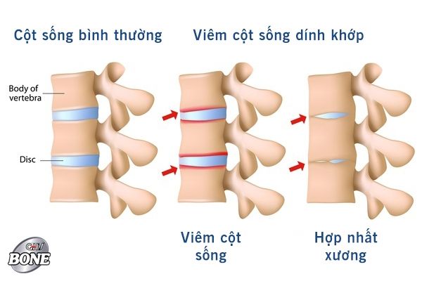 Hình ảnh mô phỏng xương hợp nhất