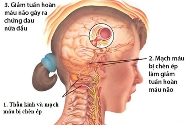 Bệnh thoái hóa khớp gây nhưng cơn đau đầu