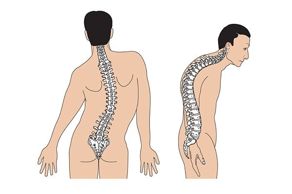 Gai cột sống gây gù, vẹo cột sống lưng