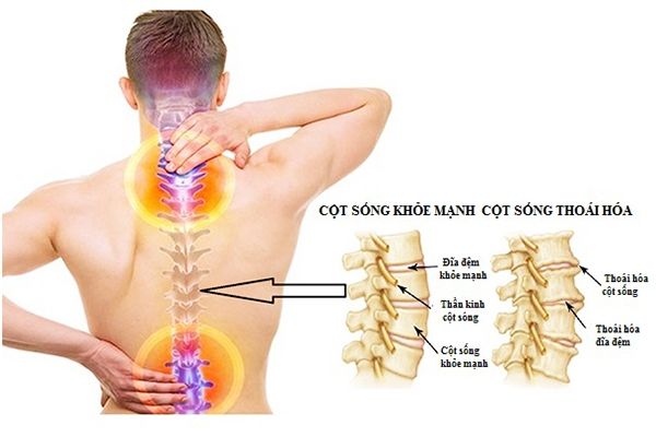 Nhận biết thoái hóa cột sống lưng khỏe mạnh và thoái hóa