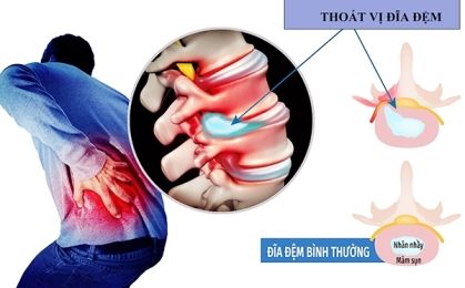 Thoát vị đĩa đệm cột sống lưng – Nguyên nhân, triệu chứng và cách điều trị