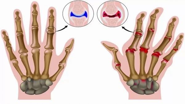 Viêm khớp dạng thấp có thể gây biến dạng khớp, cứng khớp và mất khả năng vận động (ảnh minh họa)