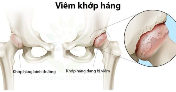 Tùy vào từng mức độ bệnh, bác sĩ sẽ tư vấn phương pháp điều trị phù hợp