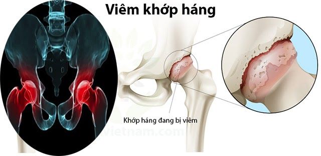 Viêm khớp háng tức thời thường phổ biến ở trẻ trong độ tuổi từ 3 – 13 tuổi