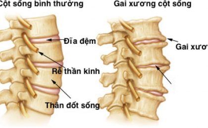 Bệnh gai cột sống thắt lưng – Những điều cần biết