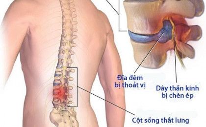      Bệnh gai cột sống thắt lưng là gì?