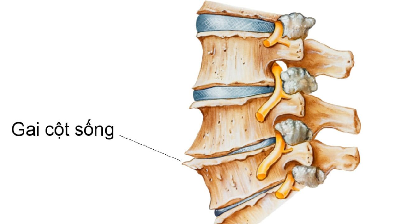 Gai cột sống là căn bệnh ảnh hưởng nhiều đến sức khỏe con người