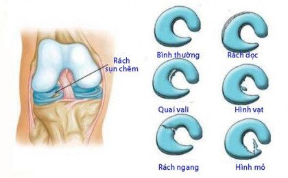 Rách sụn chêm khớp gối: Dấu hiệu, nguyên nhân và cách điều trị