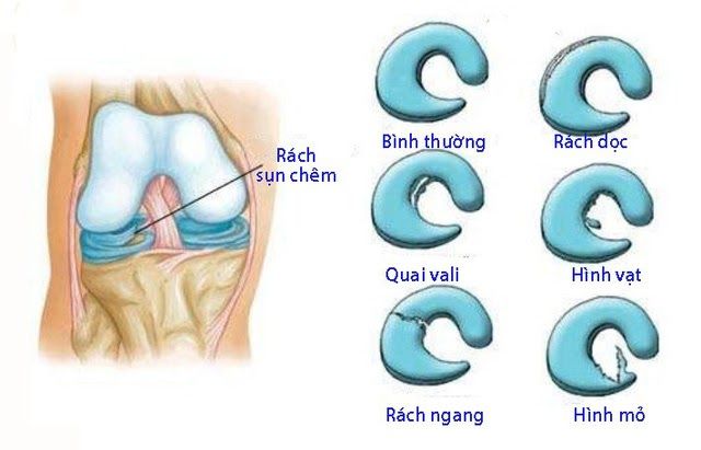 Rách sụn chêm khớp gối là tình trạng chấn thương phổ biến