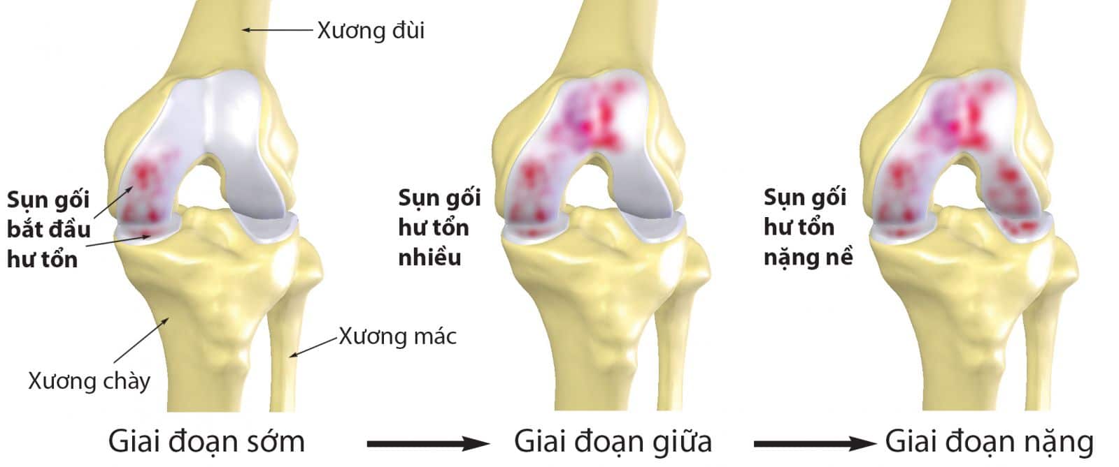 Rách sụn khớp gối ảnh hưởng lớn tới sức khỏe người bệnh