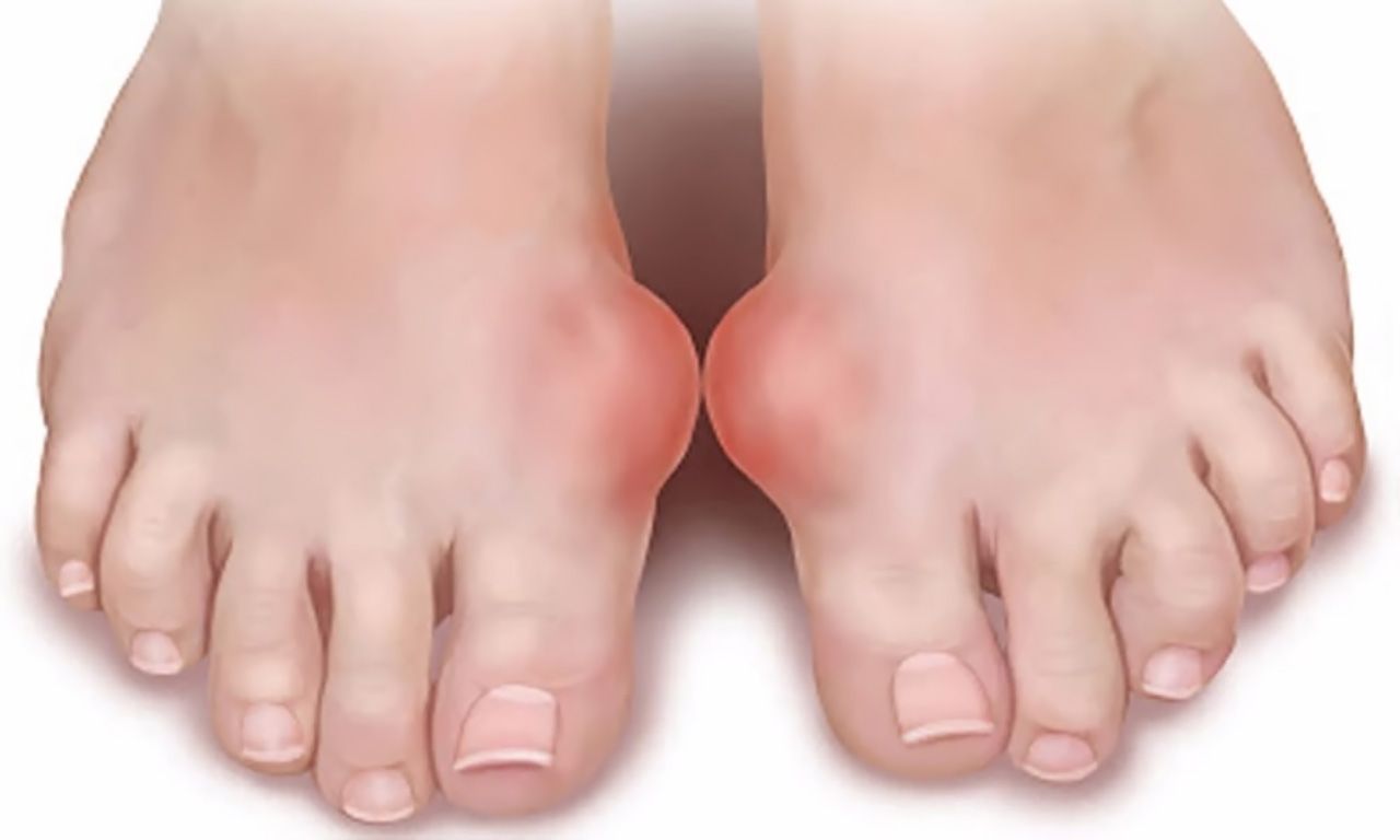 Bệnh gout là tình trạng viêm các khớp, đặc biệt là khớp gối