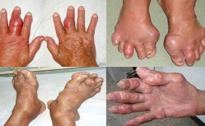 Những triệu chứng của bệnh gout