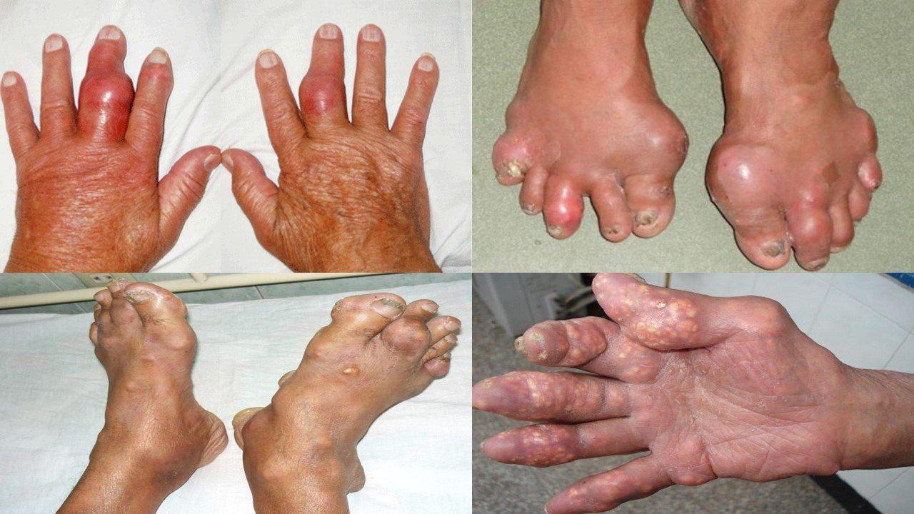 Khớp sưng, nóng, đỏ, đau,... là những triệu chứng của bệnh gout