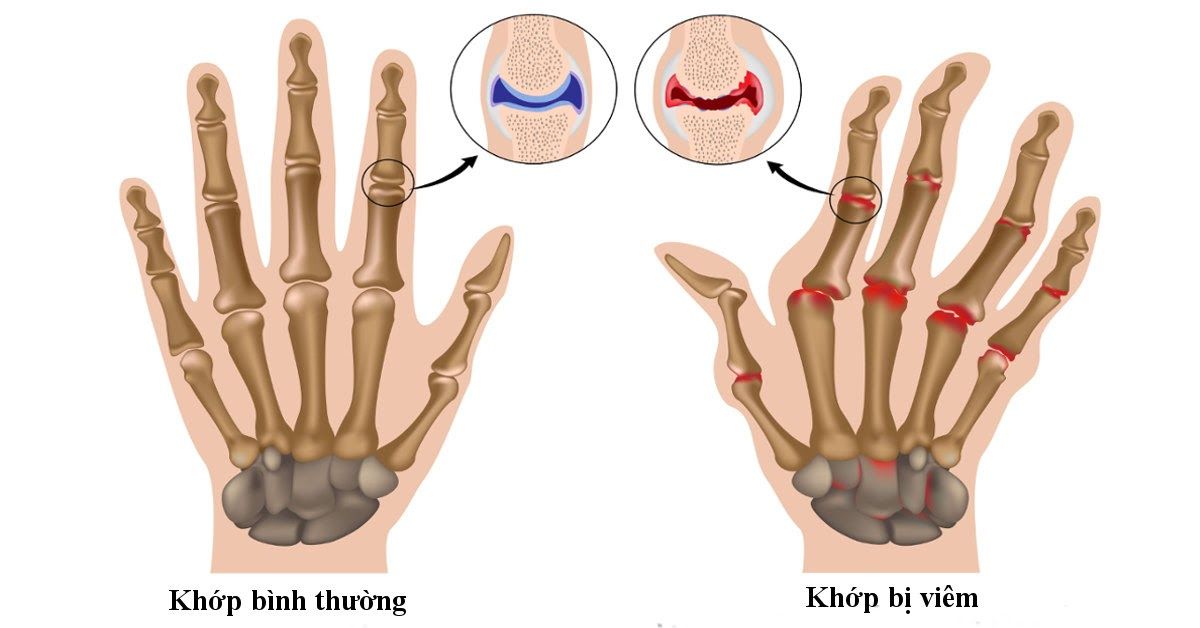 Nhận biết sớm các triệu chứng của viêm đa khớp là gì giúp tăng hiệu quả điều trị bệnh