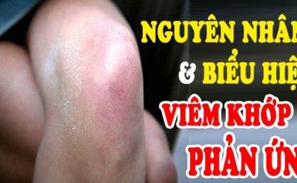 Bệnh nhân viêm khớp phản ứng cần kiêng gì?