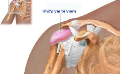 Bệnh viêm khớp vai thường gặp ở những người từ 50 tuổi trở lên