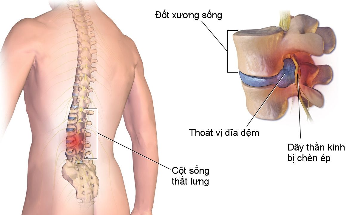 Đau quặn thắt ở vùng, eo, cổ,... là những biểu hiện của gai cột sống