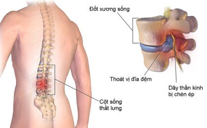 Thoái hóa đĩa đệm cột sống thắt lưng và 4 phương pháp điều trị phổ biến hiện nay