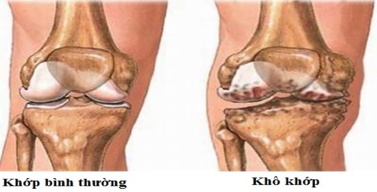 4. Vị trí khô khớp phổ biến