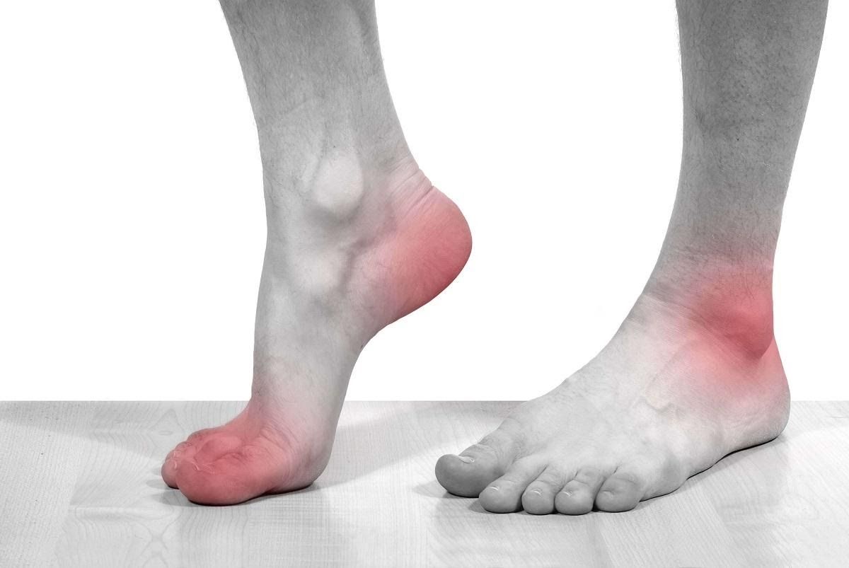 Biến chứng gout cực kỳ nguy hiểm từ bệnh thoái hóa khớp